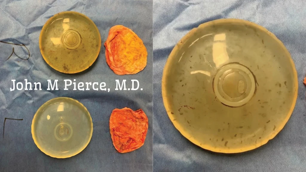 John M. Pierce, MD, Desert Plastic Surgery, fungi-filled breast implant, saline