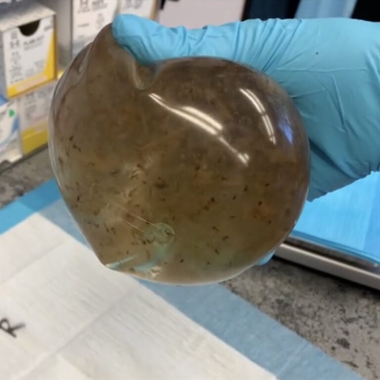 Moldy Breast Implants Came ‘Close to Killing Me’ Surgical Times
