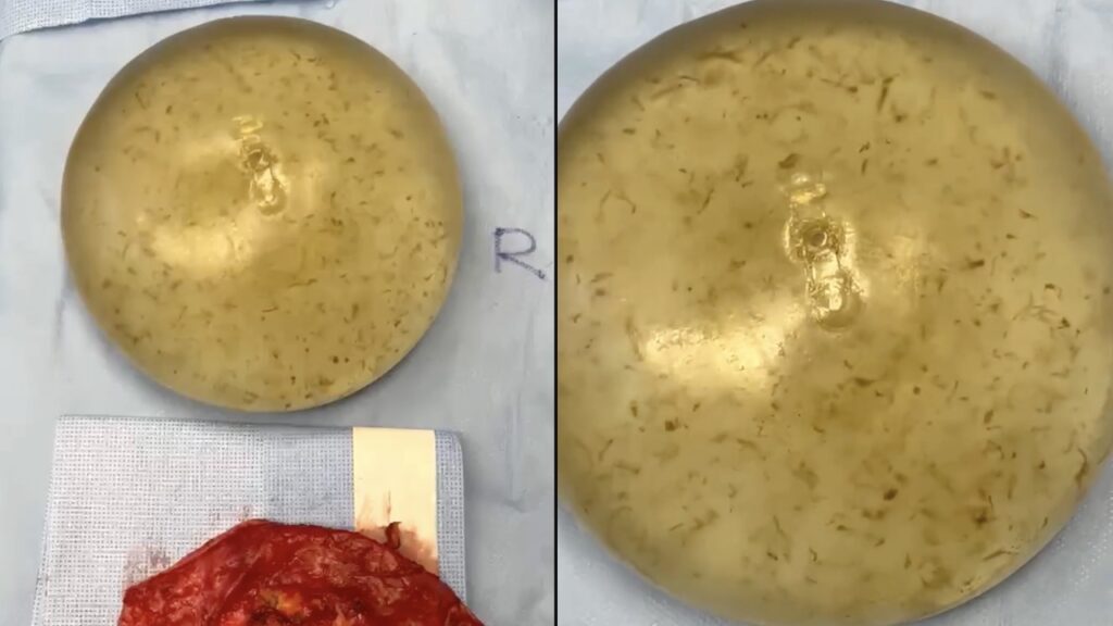 breast implant sea monkeys betadine mold