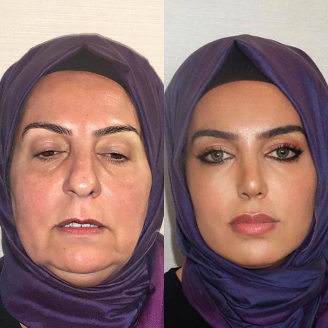 Turkish Facelift Pics Raise Praise, Eyebrows, and Red Flags Surgical