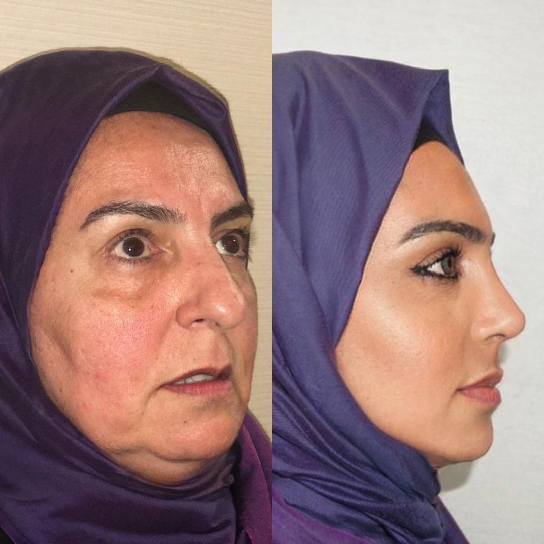 Turkish Facelift Pics Raise Praise, Eyebrows, and Red Flags Surgical