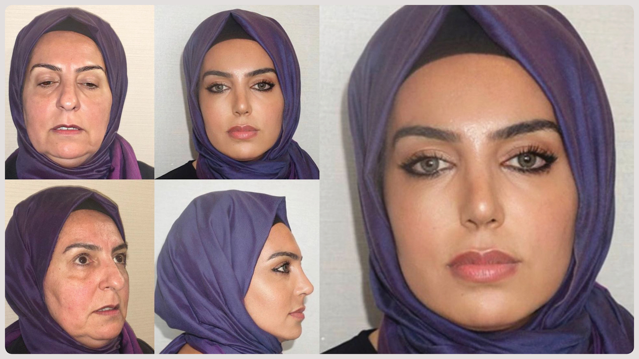 Turkish Facelift Pics Raise Praise, Eyebrows, and Red Flags Surgical